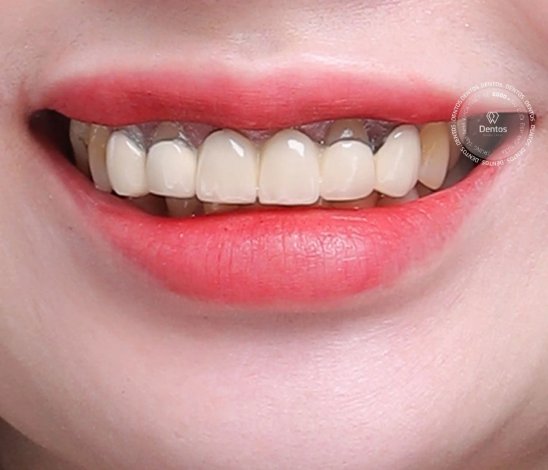 Làm lại răng sứ cũ: Khi nào cần? Làm có đau không?